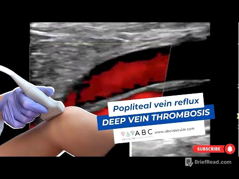 Popliteal vein reflux after deep vein thrombosis | Ultrasound