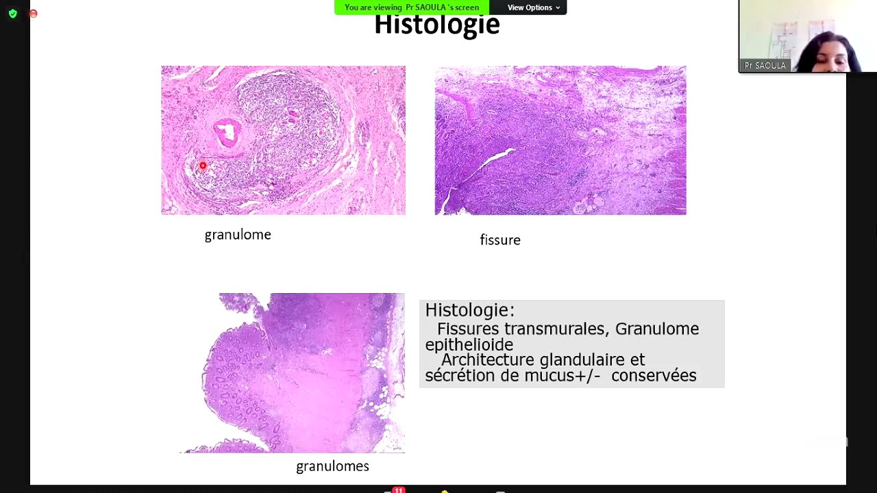 MICI -  Maladie de Crohn Pr Saoula - Cours officiel de la faculté de médecine d'Alger