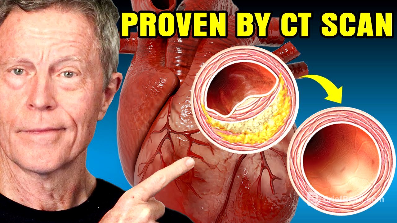 I Reversed 20 Years of Arterial Plaque... And GOT the Scan to PROVE IT
