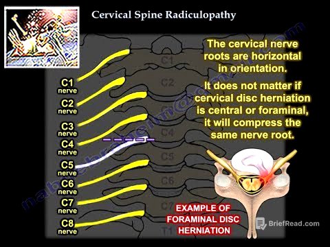 Cervical Radiculopathy - Everything You Need To Know - Dr. Nabil Ebraheim