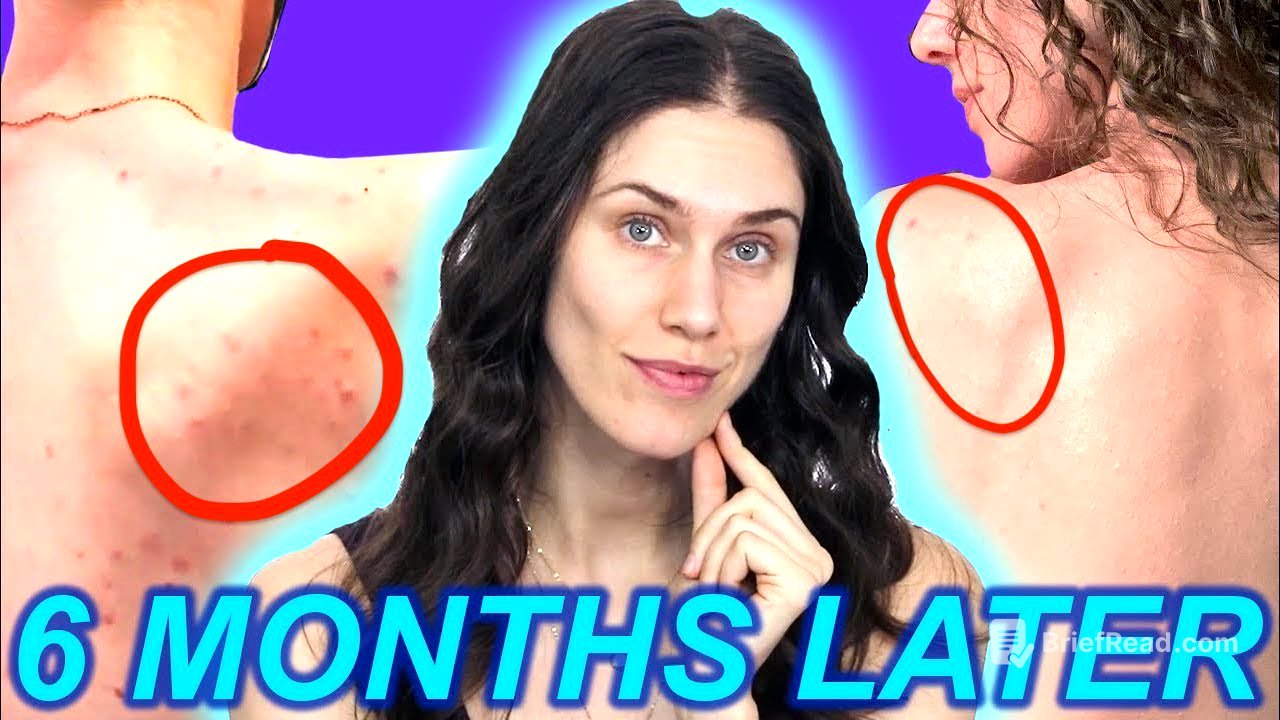 How I FINALLY Got my Body Acne to Behave...