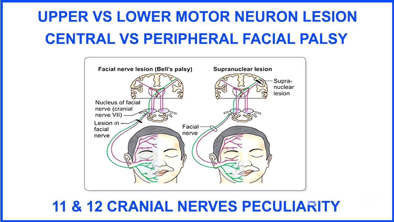 UPPER VS LOWER MOTOR NEURON LESION,CENTRAL VS PERIPHERAL FACIAL PALSY,11&12CRANIAL NERVE PECULIARITY