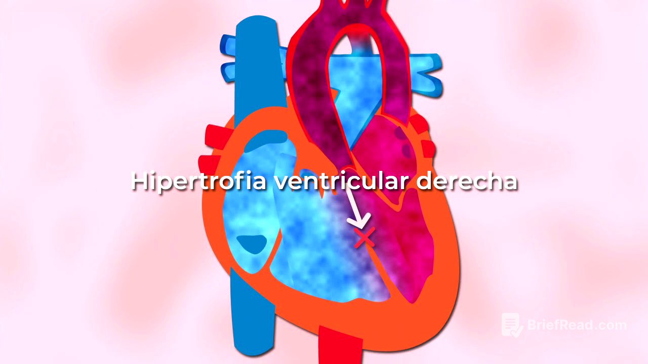 Tetralogía de Fallot