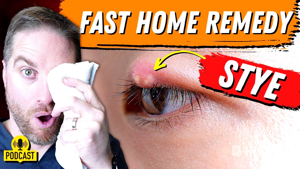 Super FAST Home Remedy For An Eyelid Stye!