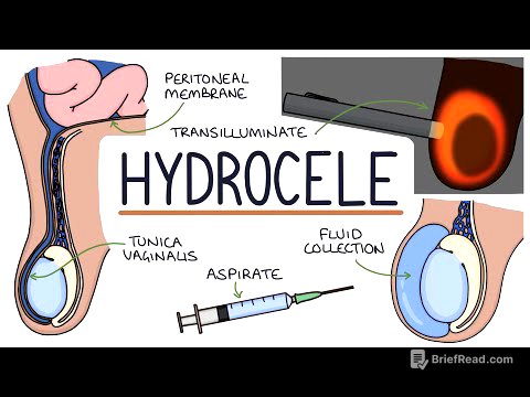 Understanding Hydroceles