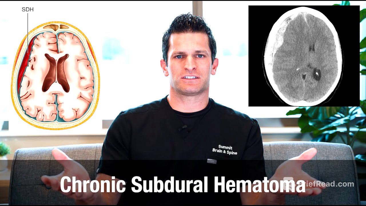 what is a Chronic Subdural Hematoma