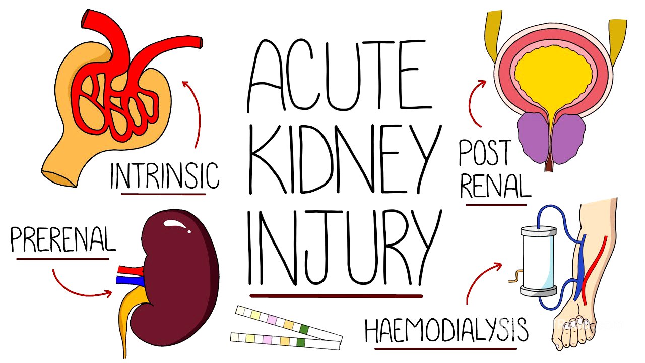 Understanding Acute Kidney Injury (AKI Made Easy)