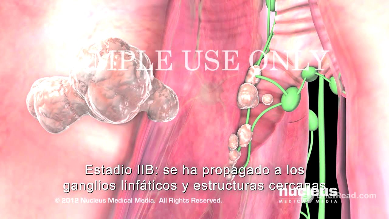 Progreso y estadificación del cáncer de pulmón