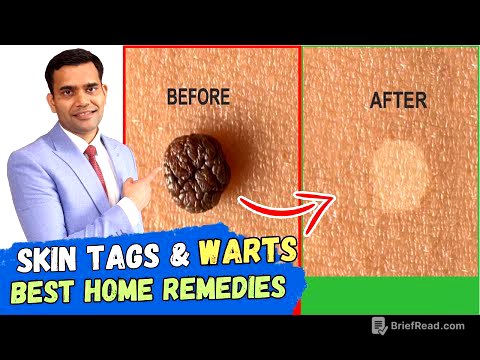 Skin Tags And Warts Will Disappear in 24 Hours - Dr. Vivek Joshi