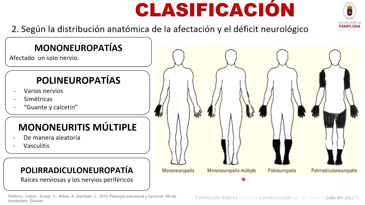 Neuropatías Periféricas [Medicina Interna]