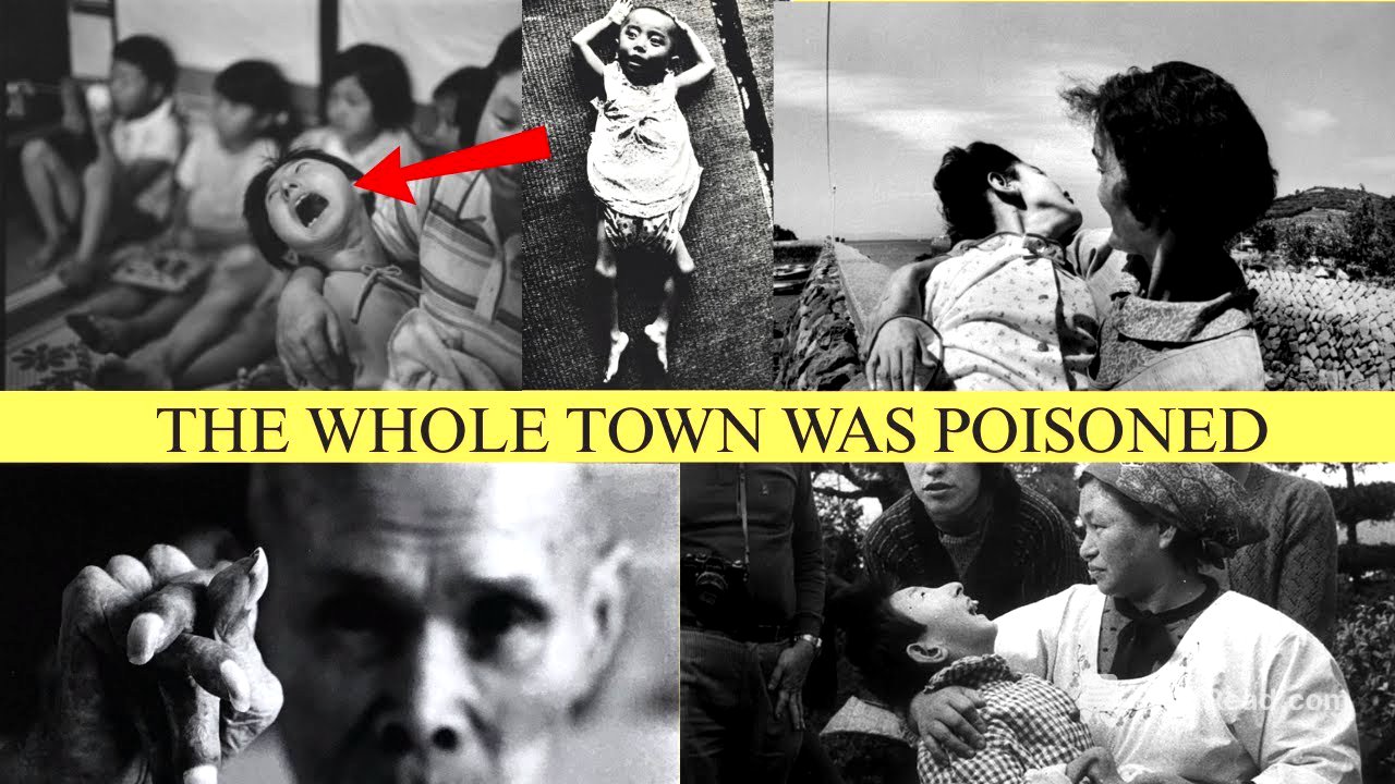 Minamata Mercury Disaster and the 'Dancing Cat Disease¨ of Japan