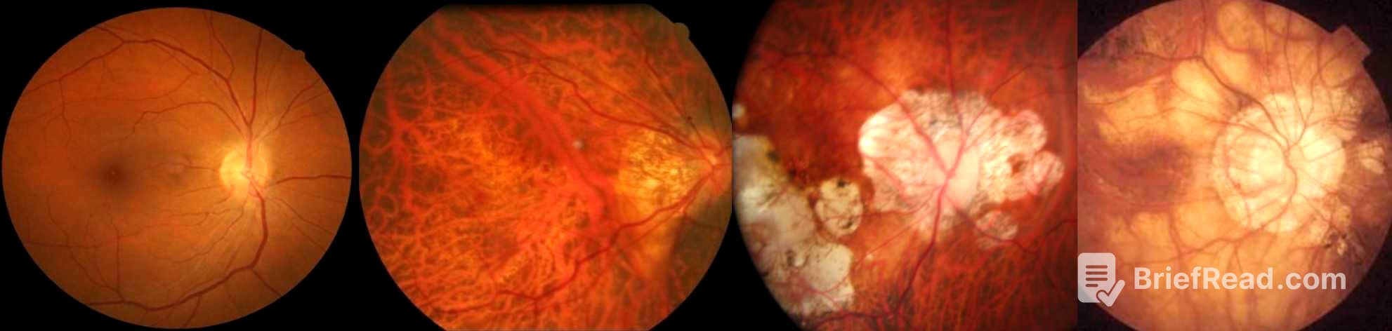 Lecture: Managing Myopia in Resource-Limited Settings: Insights & Innovations | Cybersight