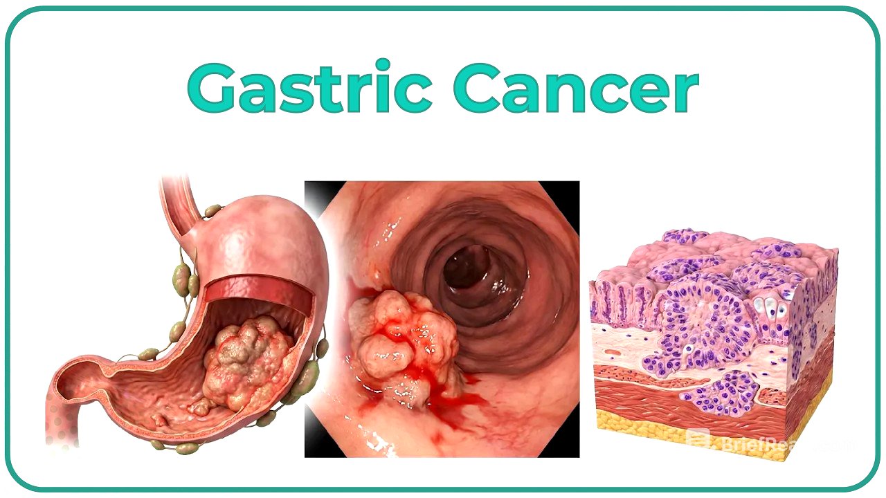 Gastric Cancer: Etiology, Risk Factors, Clinical features, Pathology, Diagnosis & Treatment - USMLE